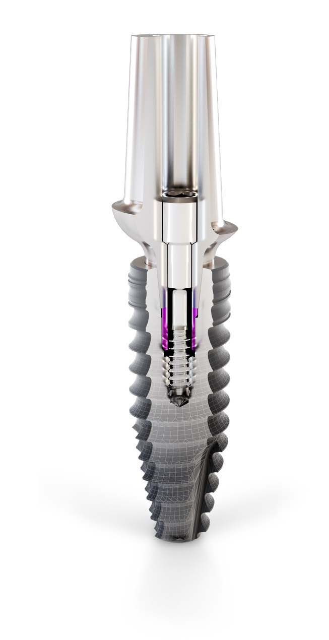 Conelog Progressive Line Implant System Conical Performance At Bone